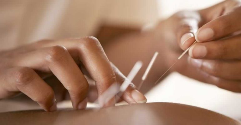 Você conhece os benefícios da acupuntura?