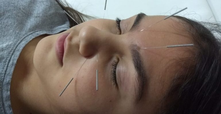 A MEDICINA CHINESA alivia a rinite alérgica e é mais eficaz do que um spray nasal com corticosteróide e anti-histamínico oral.