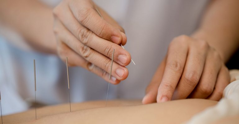 Acupuntura: o que é, benefícios e como diminui ansiedade